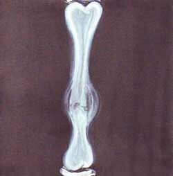 EMF effects on bones: hypertrophic pseudarthrosis